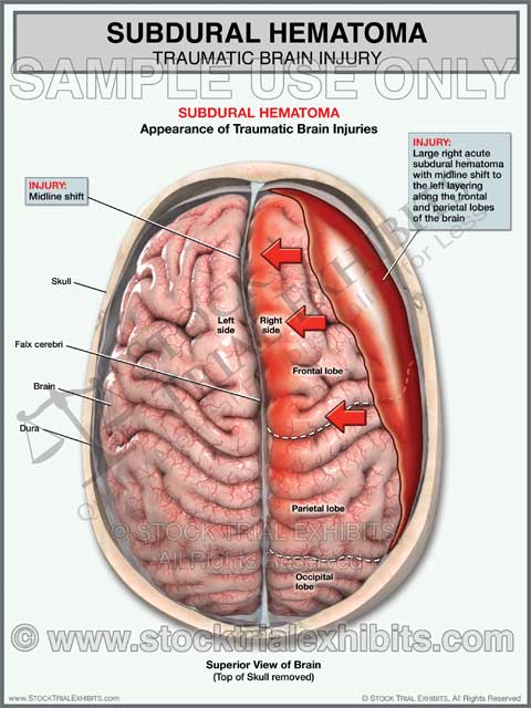 Brain Injury Subdural Hematoma (Right Side)