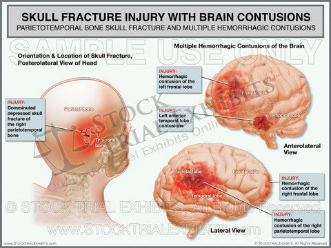 Brain contusions skull fracture stock medical illustration trial exhibit