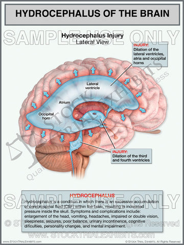 Brain Injury Hydrocephalus