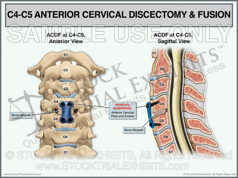 C4-C5 ACDF Anterior Cervical Discectomy and Fusion
