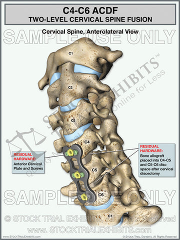 Cervical Spine Fusion C4-C6 ACDF