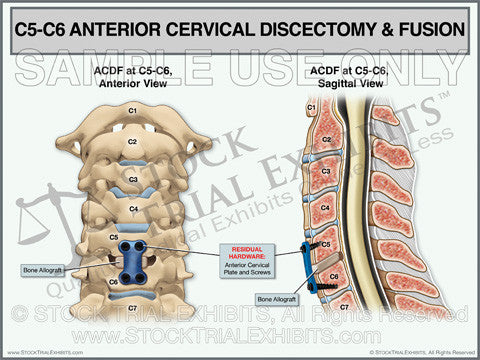 C5-C6 ACDF Anterior Cervical Discectomy and Fusion