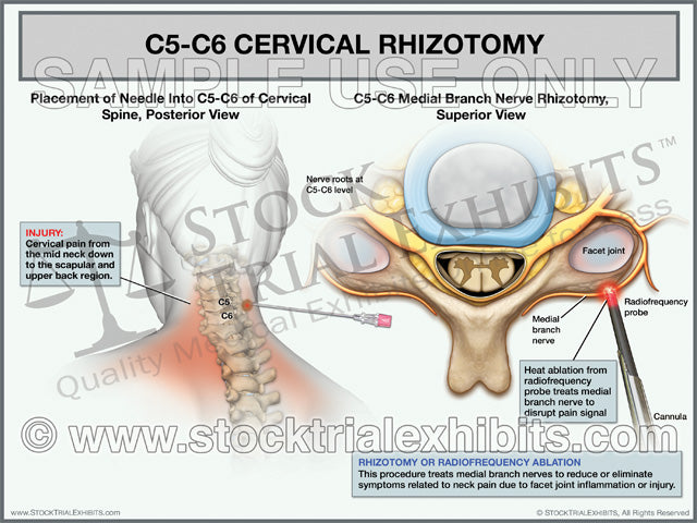C5-C6 Cervical Rhizotomy Trial Exhibit (Female) – Stock Trial Exhibits. This trial exhibit features orientation and placement of needle into the cervical spine and includes a graphic depiction of the procedure. Close up view of C5-C6 Rhizotomy - Radiofrequency Ablation procedure showing heat ablation from a radiofrequency probe on the medial branch nerve to disrupt the pain signal and reduce or eliminate symptoms related to neck pain due to facet joint inflammation or injury. 
