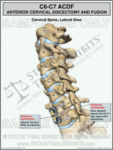 Digital Trial Exhibit ACDF C6-C7 Anterior Cervical Discectomy and Fusion