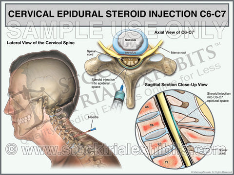C6-C7 Cervical Epidural Steroid Injection Trial Exhibit (Male)