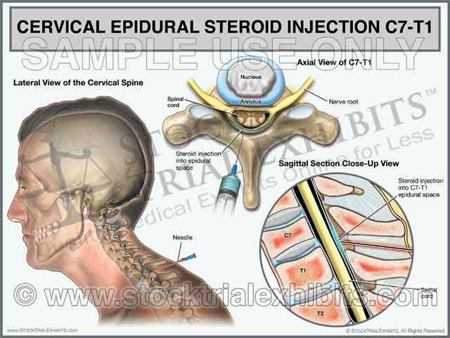 C7-T1 Cervical Epidural Steroid Injection Trial Exhibit (Male)