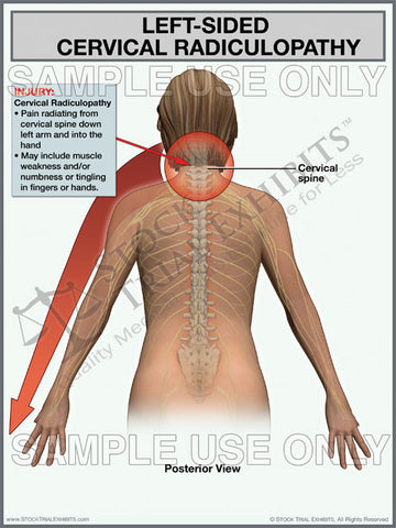 Cervical Radiculopathy Left Side Trial Exhibit (Female)