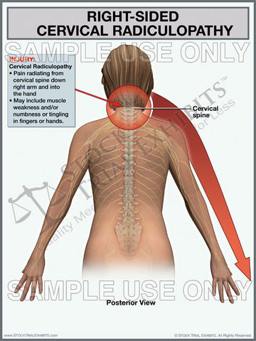 Cervical Radiculopathy Right Side Trial Exhibit (Female)