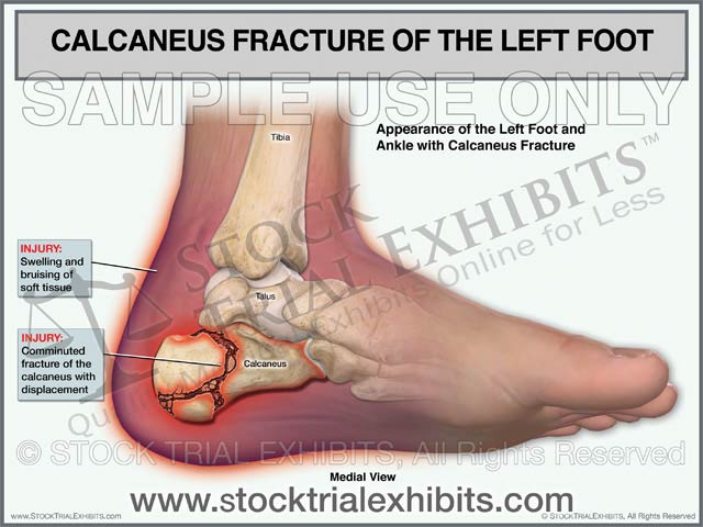 Calcaneus Fracture of the Left Foot