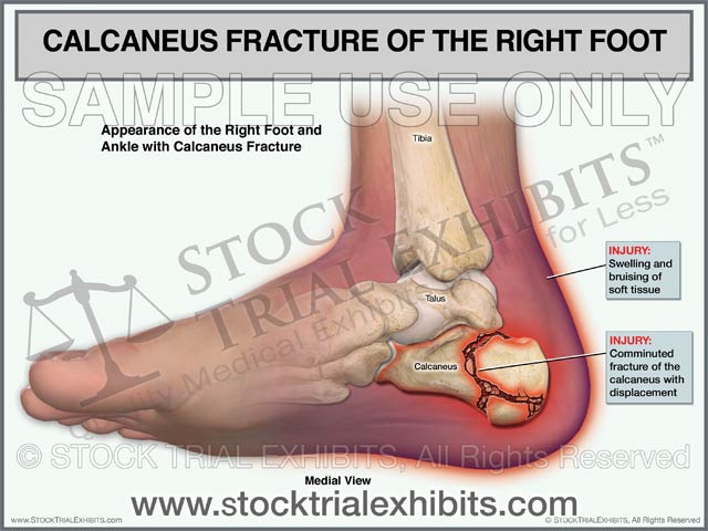 Calcaneus Fracture of the Right Foot