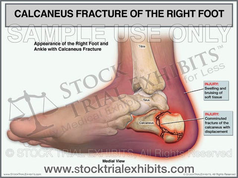 Calcaneus Fracture of the Right Foot