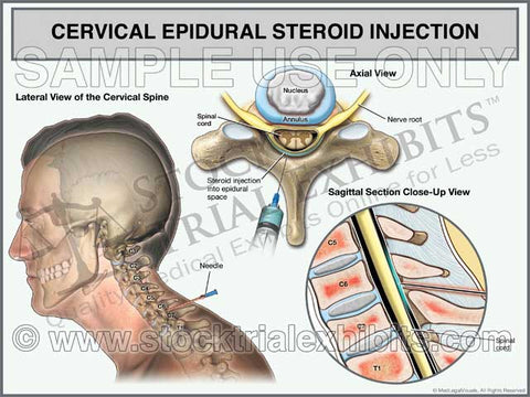 Cervical Epidural Steroid Injection Trial Exhibit (Male)