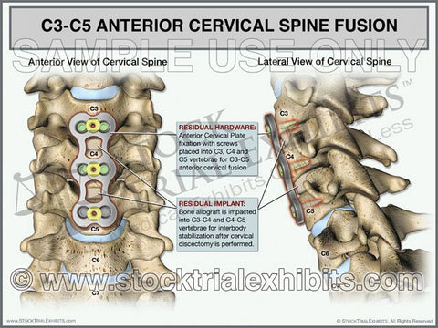 Cervical Spine Fusion C3-C5 ACDF, two views