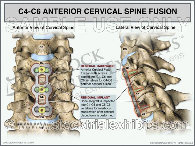This trial exhibit graphically depicts a two-level ACDF procedure at the C4-C6 levels in the anterior and lateral views. Medical illustrations show the postoperative cervical spine with plate and screws hardware, and with bone allografts inserted into C4-C5 and C5-C6 levels for stabilization. The exhibit includes descriptive labels of cervical anatomy and postoperative residual hardware. 