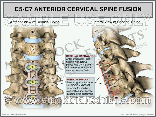 This trial exhibit graphically depicts a two-level ACDF procedure at the C5-C7 levels in the anterior and lateral views. Medical illustrations show the postoperative cervical spine with plate and screws hardware, and with bone allografts inserted into C5-C6 and C6-C7 levels for stabilization. The exhibit includes descriptive labels of cervical anatomy and postoperative residual hardware. 