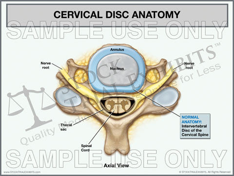 Cervical Disc Anatomy Trial Exhibit (Axial View)