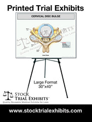 Cervical disc bulge trial exhibit large printed exhibit