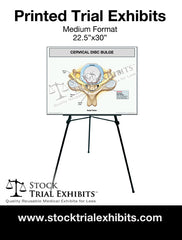 Cervical disc bulge Trial Exhibit printed