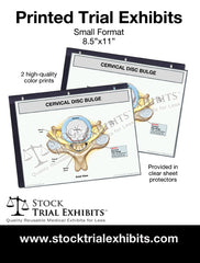 Cervical disc bulge stock medical illustration small prints
