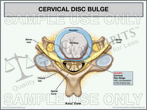 Cervical Disc Bulge Trial Exhibit (Axial View)