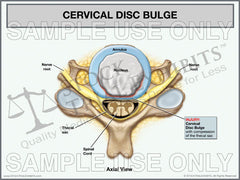 Cervical Disc Bulge Stock Medical Illustration Trial Exhibit