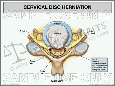 Cervical Disc Herniation Stock Medical Illustration