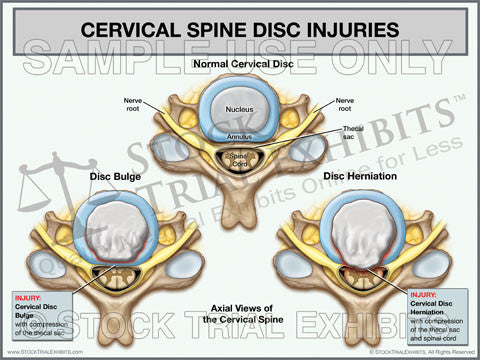 Cervical Disc Injuries Trial Exhibit (Axial View)
