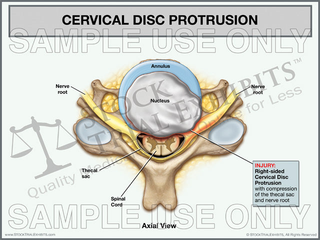 Cervical Disc Protrusion, Right-Sided