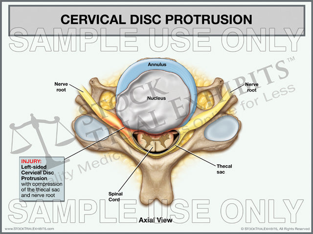 Cervical Disc Protrusion, Left-Sided