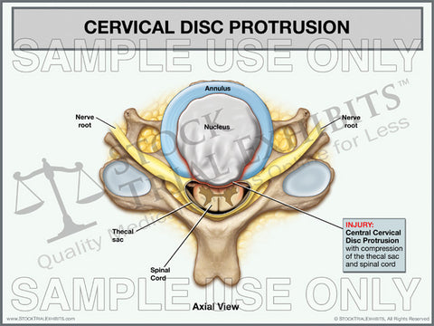 Cervical Disc Protrusion