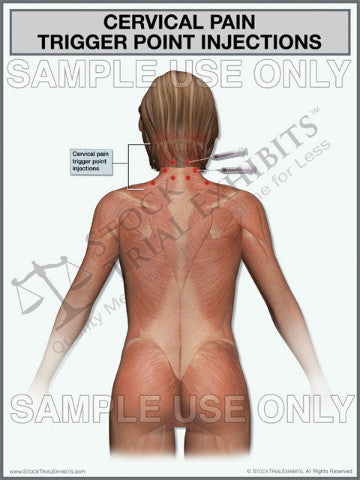 Cervical Pain Trigger Point Injections Exhibit (Female)
