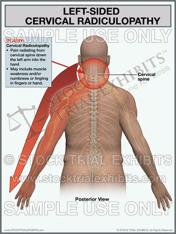 Cervical Radiculopathy Left Side Trial Exhibit (Male)
