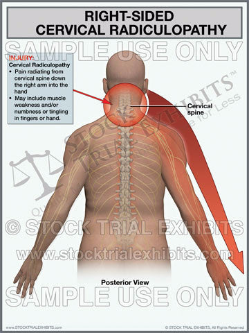 Cervical Radiculopathy Right Side Trial Exhibit (Male)
