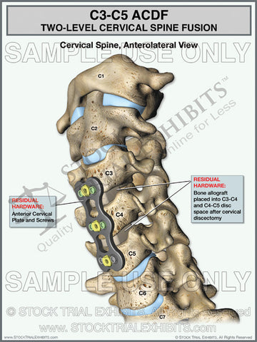 Cervical Spine Fusion C3-C5 ACDF