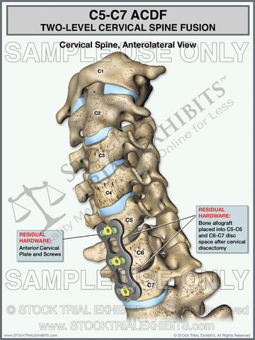 Cervical Spine Fusion C5-C7 ACDF