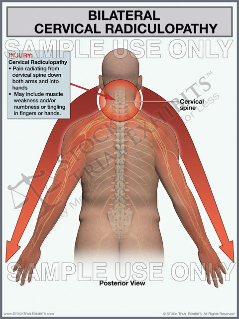 Bilateral Cervical Radiculopathy