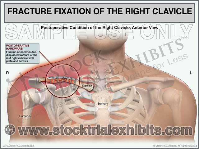 This trial exhibit graphically depicts the postoperative condition of a right mid clavicle fracture with fixation of fracture using plate and screws hardware, shown in the anterior view. This stock medical exhibit includes detailed medical illustration of a postoperative right clavicle fracture injury with residual hardware and includes descriptive labels of the injury, anatomy and hardware.