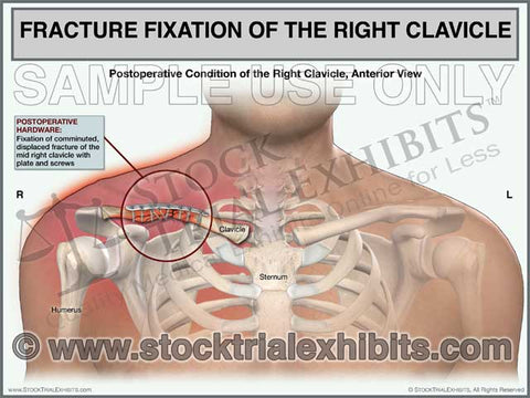Clavicle Fracture with Fixation Right Side (Male)