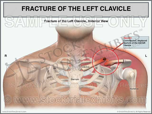 This trial exhibit graphically depicts a comminuted, displaced, left mid clavicle fracture injury with soft tissue swelling and bruising of the left shoulder area, shown in the anterior view. This stock medical exhibit includes detailed medical illustration of a comminuted, displaced mid clavicle fracture with descriptive labels of the injury.