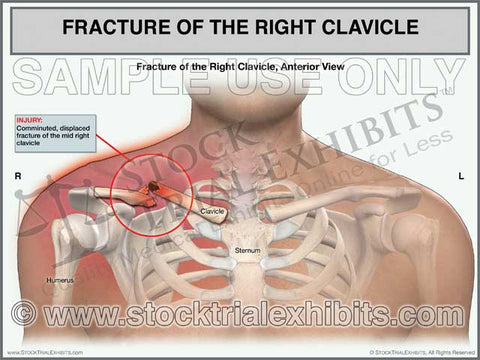 Clavicle Fracture Right Side (Male)