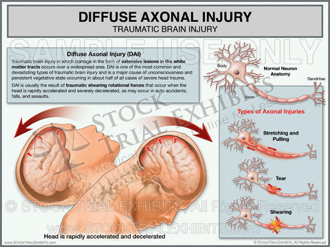 Brain Injury Diffuse Axonal Injury Trial Exhibit