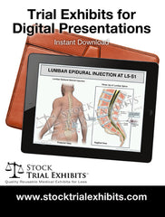 Digital Presentation Lumbar Epidural Injection Male L5-S1 Medical Trial Exhibit