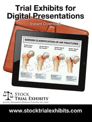 Digital Presentation Garden Classification of Hip Fractures Trial Exhibit