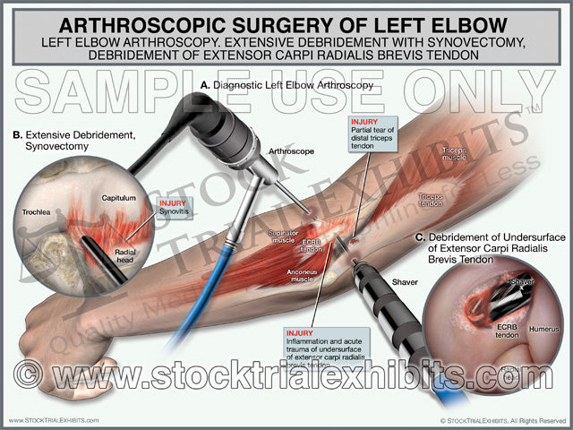 Elbow Arthroscopy with Debridement of Left Elbow