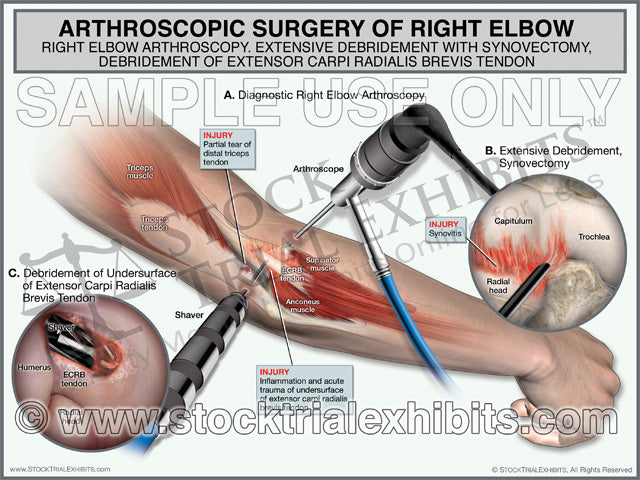 Elbow Arthroscopy with Debridement of Right Elbow