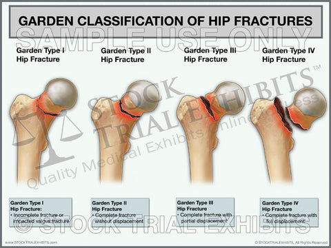 Stock Lower Limb: Orthopedic — Illustrated Verdict