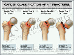 Garden Classification of Hip Fractures Medical Trial Exhibit