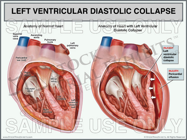 Heart Left Ventricular Diastolic Collapse trial exhibit. This trial exhibit depicts the normal anatomy of the heart ventricles compared to the anatomy of a heart with pericardial effusion (fluid, blood, cardiac tamponade) resulting in left ventricular diastolic collapse. 