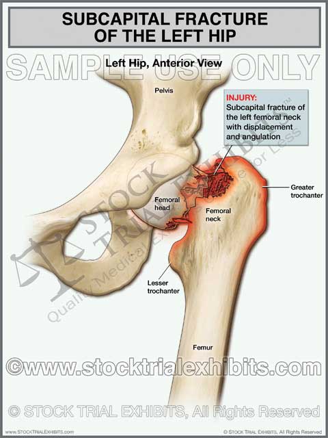 This trial exhibit graphically depicts a subcapital fracture of the left femoral neck with displacement and angulation. The exhibit includes descriptive labels of the fracture injury and anatomy, shown in the anterior view. 