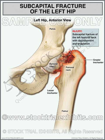 Hip Fracture - Subcapital Fracture of the Left Hip